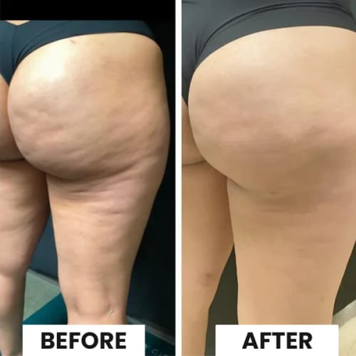 BodyLiftPro™ | Elimine la cellulite et raffermit la peau